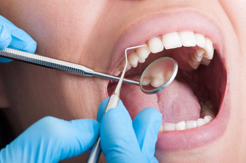 ماذا يحدث أثناء تنظيف الأسنان العميق (التقليح وكشط الجذور) في عيادة الأسنان؟