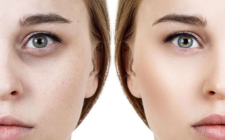 تشقير الوجه في حائل