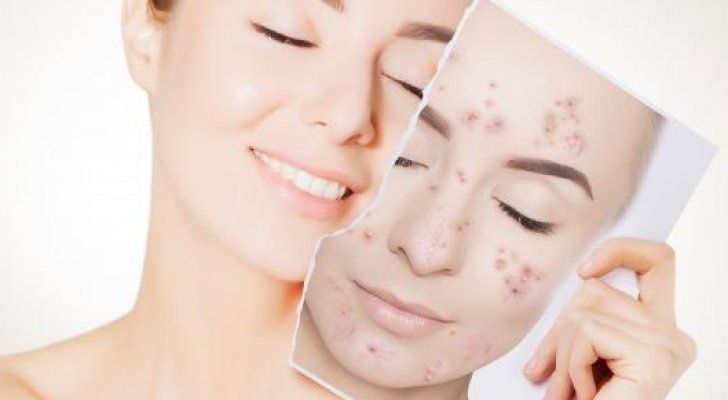 تفتيح البشرة في حائل